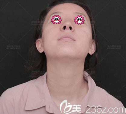 我找北京沃爾劉彥軍醫(yī)生做鼻綜合修復(fù)第7天樣子