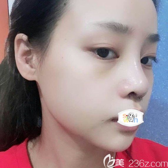 孝感天妃柳肖隆鼻術(shù)后7天恢復(fù)照片