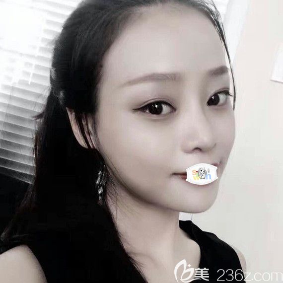 孝感天妃柳肖鼻綜合隆鼻1個(gè)月恢復(fù)圖