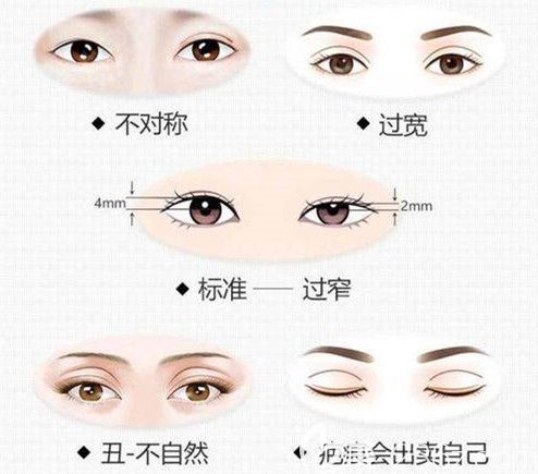 雙眼皮失敗常見的情況