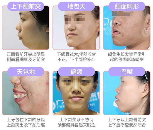 偏頜導致臉歪怎么辦 偏頜導致臉歪怎么辦