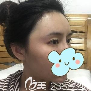 張國軍主任幫我做自體脂肪豐額頭15天后腫脹漸消 張國軍主任幫我做自體脂肪豐額頭15天后腫脹漸消