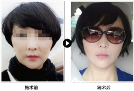 韓國普羅菲耳醫(yī)院小切口提升案例