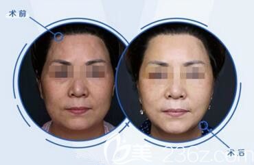 韓國profile普羅菲耳樸明旭院長小切口三重提升真人前后對比效果照