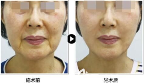 韓國profile醫(yī)院樸明旭院長小切口提升案例