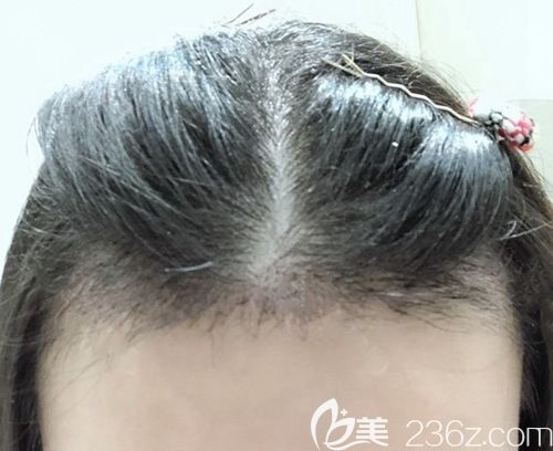 我找重慶華美植發(fā)的陳善友醫(yī)生做發(fā)際線種植 恰逢院慶前500株特價手術(shù)總共花了2萬不到