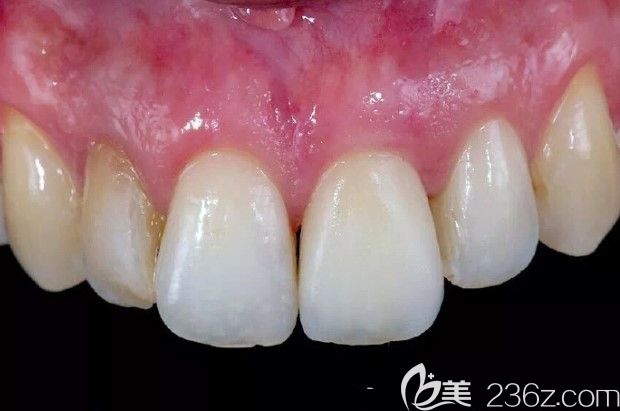 北京佳美口腔種植牙效果圖