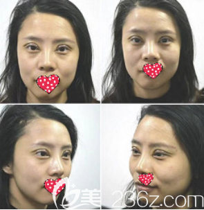 術(shù)后一周 術(shù)后一周