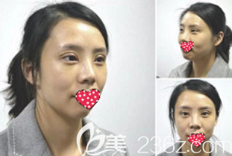 術(shù)后15天 術(shù)后15天