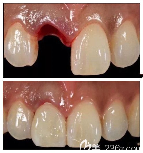 30多歲門牙意外折斷顧客在佳美種牙案對(duì)比圖 30多歲門牙意外折斷顧客在佳美種牙案對(duì)比圖