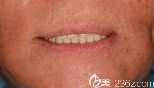 60歲老人佳美口腔做全口種植牙效果圖 60歲老人佳美口腔做全口種植牙效果圖