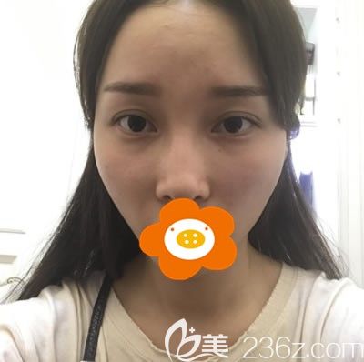 在福州比華利做自體脂肪填充術(shù)前照 在福州比華利做自體脂肪填充術(shù)前照