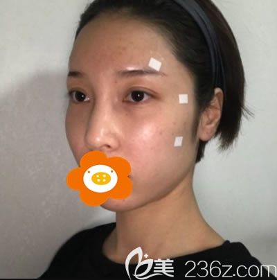 術(shù)后3天效果 術(shù)后3天效果