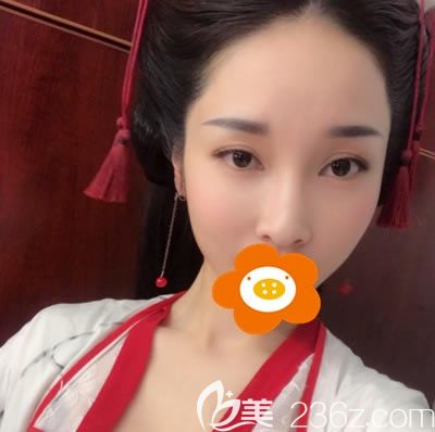 做自體脂肪全臉填充15天拍的寫(xiě)真 做自體脂肪全臉填充15天拍的寫(xiě)真