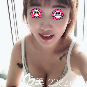 宋延剛醫(yī)生給我做吸脂豐胸1個(gè)月效果 宋延剛醫(yī)生給我做吸脂豐胸1個(gè)月效果