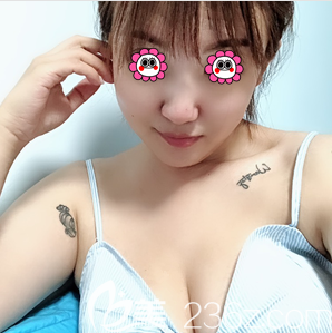 北京美萊宋延剛自體脂肪豐胸案例 北京美萊宋延剛自體脂肪豐胸案例