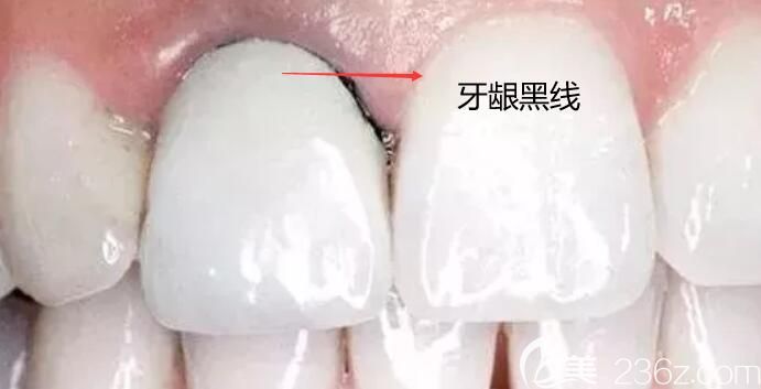 烤瓷牙牙齦黑線