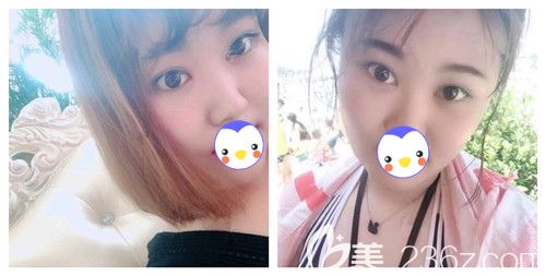 靠偏方消除天生腫泡眼是不可能了 幸好我早早來唐山蘇亞美聯(lián)臣做全切雙眼皮+開眼角才擁有現(xiàn)在的靈動大眼