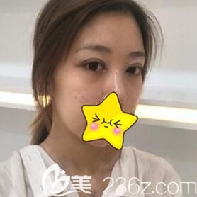 在沈陽騰采做雙眼皮術(shù)后一周拆線