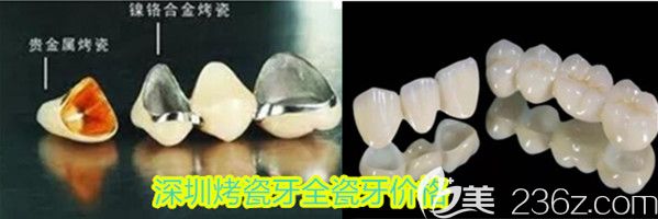 深圳烤瓷牙和全瓷牙價(jià)格