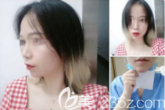 術后第三天 術后第三天