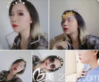 術后36天 術后36天