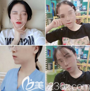 術后40天 術后40天