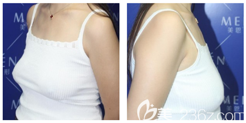 廣州美恩整形醫(yī)院許揚濱醫(yī)生不僅鼻子做得好自體脂肪隆胸案例效果也很不錯哦 廣州美恩整形醫(yī)院許揚濱醫(yī)生不僅鼻子做得好自體脂肪隆胸案例效果也很不錯哦