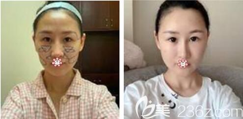 手術(shù)后兩天的樣子