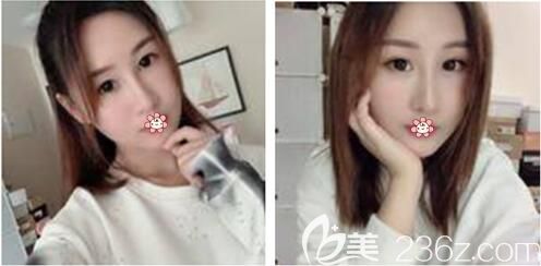 鄭楠醫(yī)生給我術(shù)后半個(gè)月