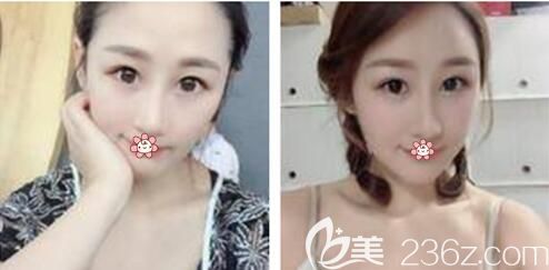 重慶美萊做脂肪填充手術(shù)怎么樣