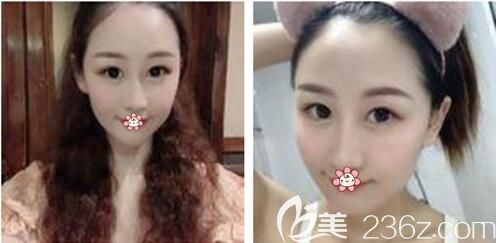 重慶美萊哪個(gè)醫(yī)生做脂肪填充好