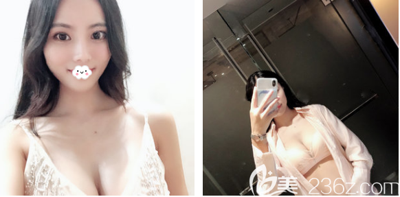 看深圳非凡整形醫(yī)院隆胸效果怎么樣