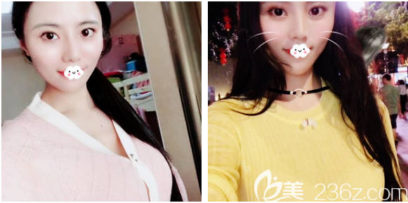 深圳非凡假體隆胸案例7天效果圖