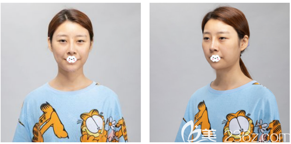 去廣州曙光做雙眼皮術(shù)前照片 去廣州曙光做雙眼皮術(shù)前照片