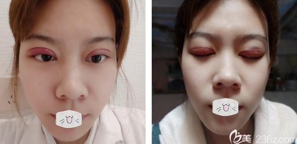 荊州雙眼皮失敗修復(fù)哪家好？華美<!--<i data=20240703-sp></i>-->眼部修復(fù)案例