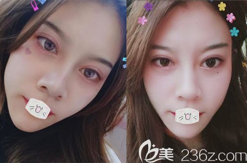 想了解荊州華美雙眼皮修復(fù)技術(shù)怎么樣的來看眼部疤痕增生出疙瘩修復(fù)案例圖