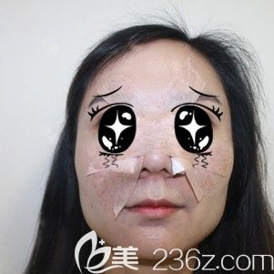 做鼻翼縮小整形術(shù)后即刻被包裹嚴(yán)實的自己