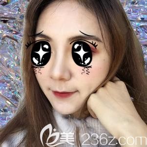 張主任幫我做鼻翼縮小術(shù)后30天鼻子消腫