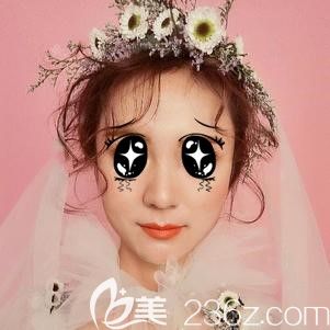 糾結鼻翼縮小術后越變越大，不如看我在太原這家醫(yī)院術后68天的真實情況再考慮要不要手術