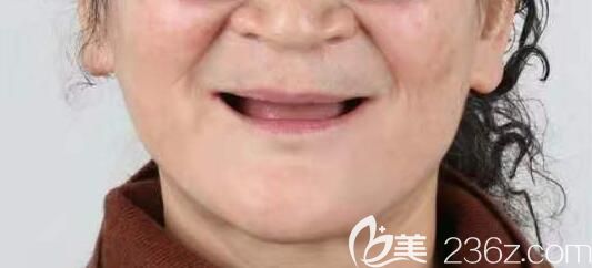 60歲的我在北京佳美口腔種植牙前 60歲的我在北京佳美口腔種植牙前