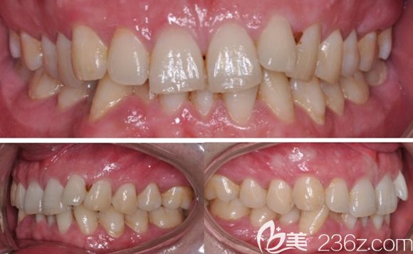 顧客在北京佳美口腔做隱適美隱形矯正術(shù)前照 顧客在北京佳美口腔做隱適美隱形矯正術(shù)前照