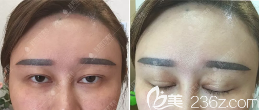 雙眼皮修復(fù)術(shù)前睜眼無力疤痕明顯 雙眼皮修復(fù)術(shù)前睜眼無力疤痕明顯