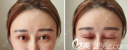 攀枝花凝美雙眼皮修復(fù)手術(shù)拆線后效果 攀枝花凝美雙眼皮修復(fù)手術(shù)拆線后效果