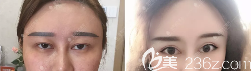 攀枝花凝美曹陽雙眼皮修復(fù)對比照 攀枝花凝美曹陽雙眼皮修復(fù)對比照
