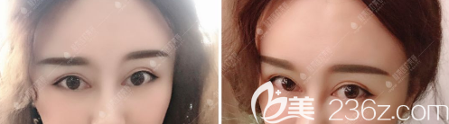 睜眼無力、閉眼疤痕明顯，攀枝花凝美曹陽院長的雙眼皮修復(fù)手術(shù)幫我找回美麗！