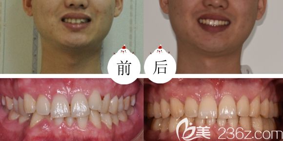 在北京佳美口腔做隱適美矯正的前后效果圖 在北京佳美口腔做隱適美矯正的前后效果圖