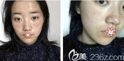 一周時(shí)候有一點(diǎn)點(diǎn)淡了 一周時(shí)候有一點(diǎn)點(diǎn)淡了