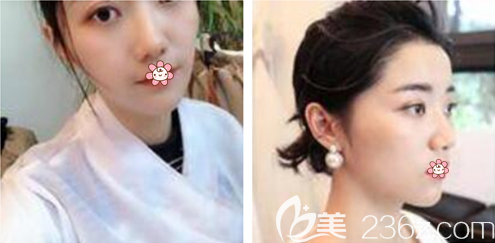 張東梅激光祛斑術(shù)后半年 張東梅激光祛斑術(shù)后半年