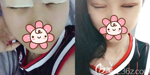 找孫振東醫(yī)生做完切開(kāi)重瞼術(shù)后